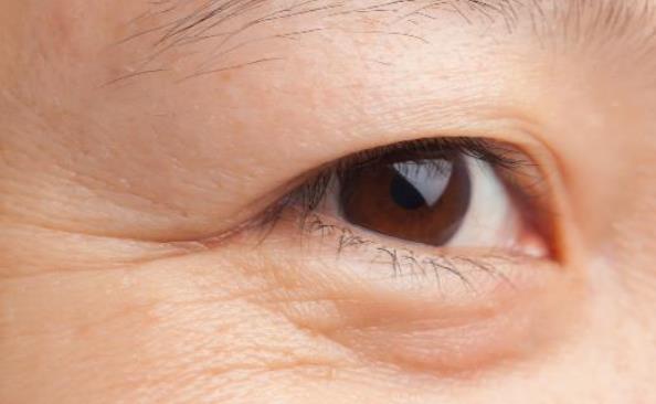 眼角皱纹长出来了 6个方法能祛除