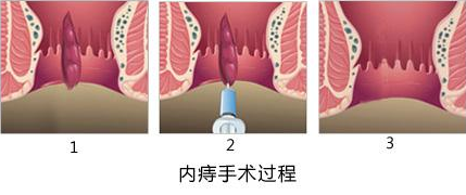 武汉江汉博仕医院：肛瘘手术多久能恢复