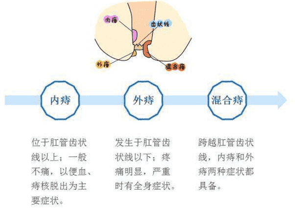 武汉江汉博仕医院 痔瘘和痔疮是一个病吗