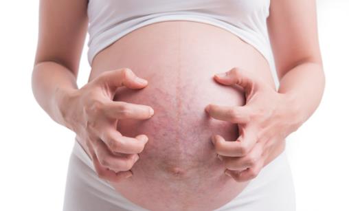 怀孕为什么会长妊娠纹？孕期如何改善妊娠纹？
