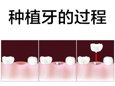 天津皓圣4颗半口种植牙图片