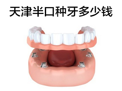 天津OSSTEM4颗半口种植牙图片