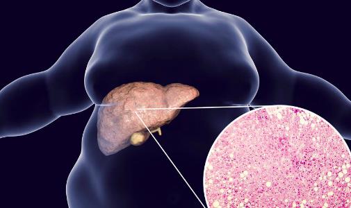 脂肪肝是怎么造成的？怎么预防脂肪肝？