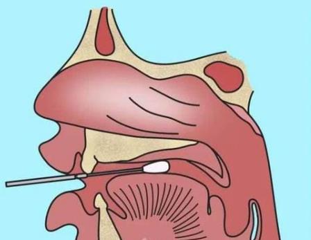 核酸检测新冠病毒的常用手段：口腔拭子、鼻腔拭子检测图示