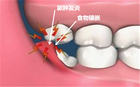 牙菌斑以及食物残渣等容易对拔智齿的创口造成感染。