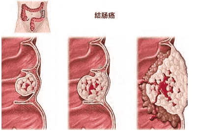 最新！武汉江汉博仕医院：肠道筛查做什么检查