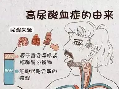 郑州痛风专家：无症状高尿酸血症，是否需要降尿酸治疗？