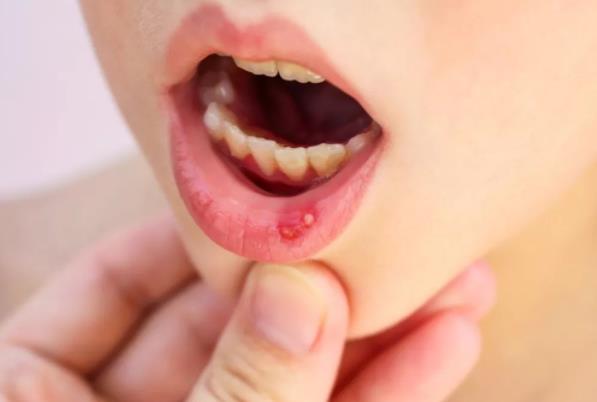 口腔溃疡是病吗？口腔溃疡是怎么引起的？