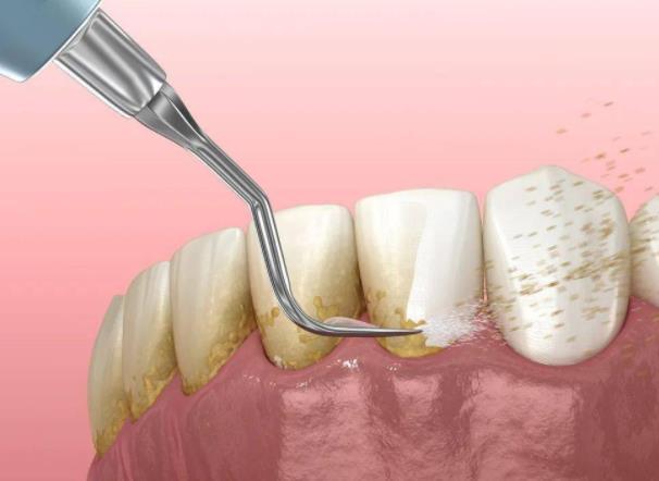 牙结石一次能完全洗干净吗？不想洗牙怎么去牙结石