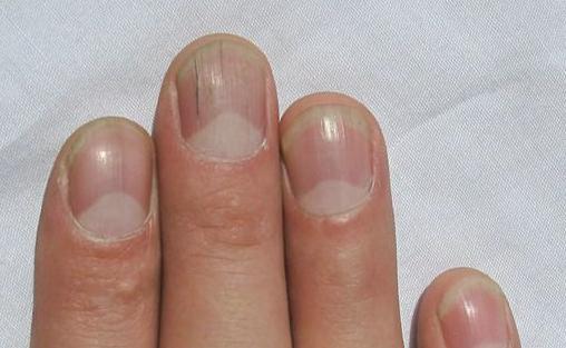 指甲有竖纹是肝脏问题吗？指甲有竖纹是身体什么信号？