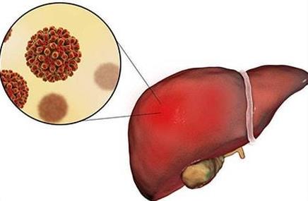 肝病怎么彻底治好？如何预防肝病