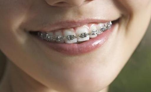 哪个年龄段适合牙齿正畸？戴牙套有哪些副作用