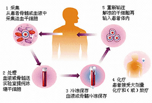 济南血液病医院科普：骨髓瘤患者自体移植前需要做好哪些准备？