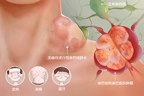 济南血液病医院科普：确诊淋巴瘤该如何治疗？自体移植效果好吗？