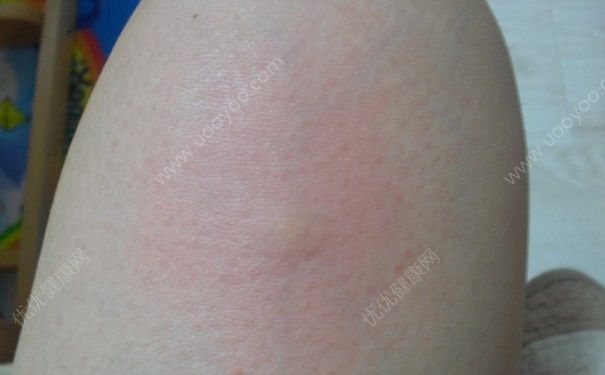 蚊子叮人吸血原因 蚊子咬人后皮肤发痒红肿症状图片