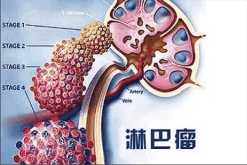 济南血液病医院科普：治疗非霍奇金淋巴瘤，化疗、移植哪个好？