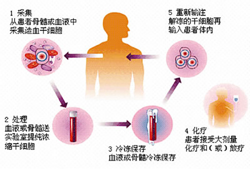 济南血液病医院科普：骨髓瘤造血干细胞移植流程介绍