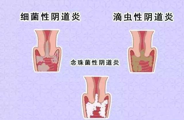 霉菌性阴道炎的表现有哪些？日常需要怎样护理？[图]