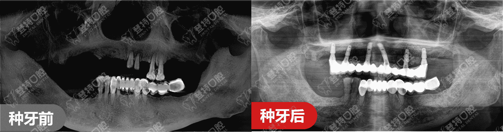 颠覆传统种牙，佛山登特口腔一日得技术，一天搞定种牙全过程