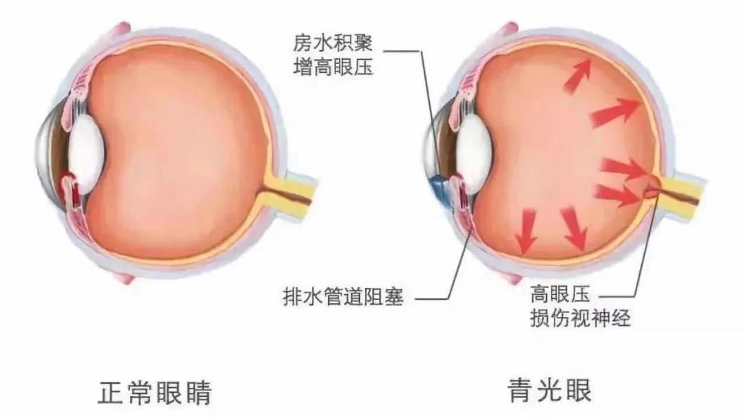 【合肥爱尔】专家提醒：慎防青光眼