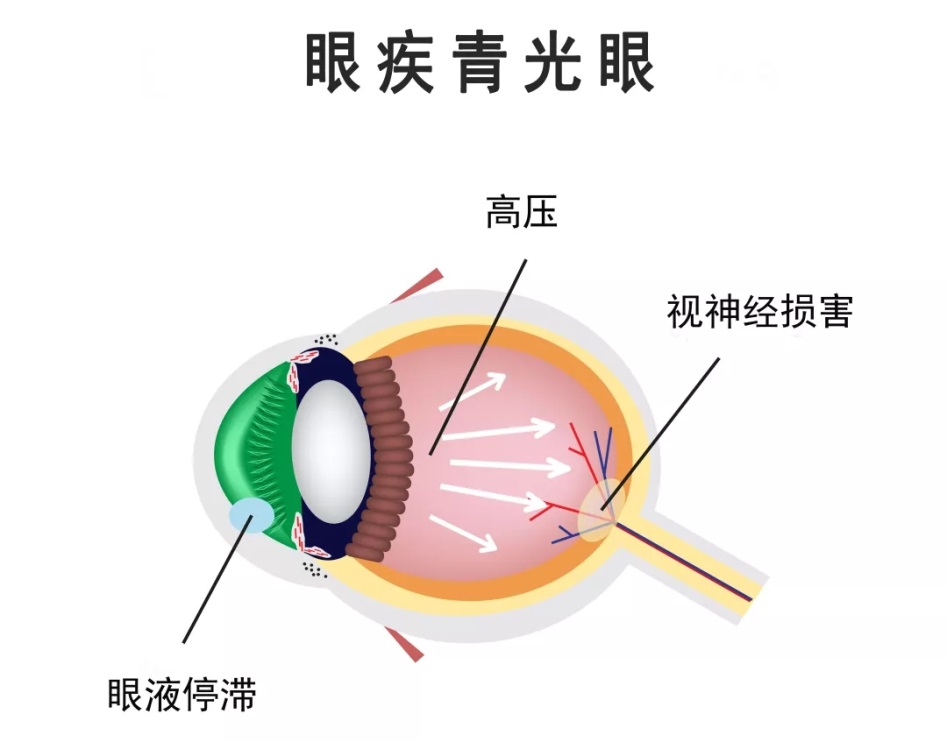 合肥爱尔眼科：青光眼预防一定要“早”