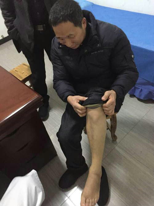 郑州痛风风湿病医院:老公半夜被痛醒让我跟他分房睡