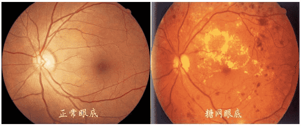 合肥爱尔眼科医院：糖尿病患者，注意定期检查眼底