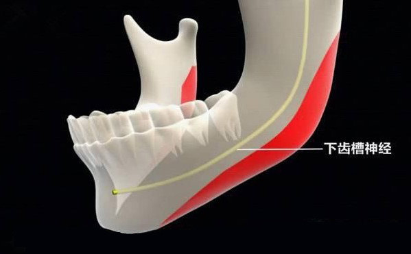 联合丽格第一医院何照华教授：下颌角手术会不会损伤神经线？
