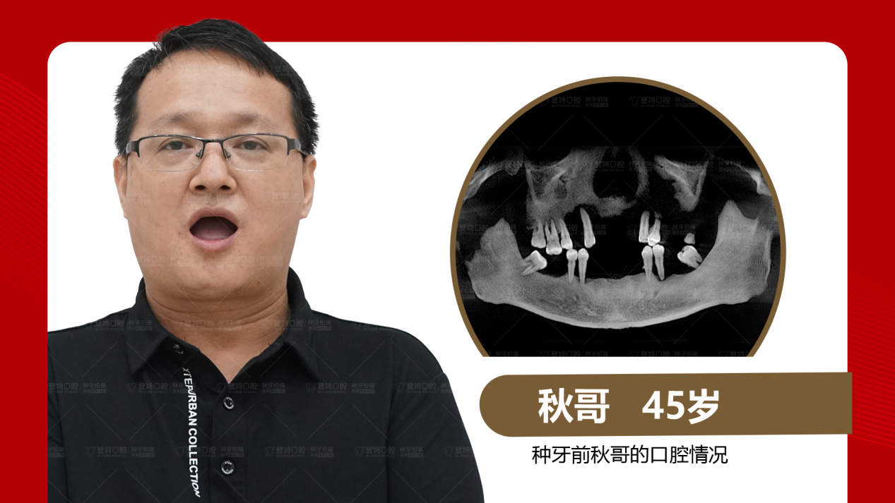 佛山登特口腔：全口半口缺牙修复方式怎么选？