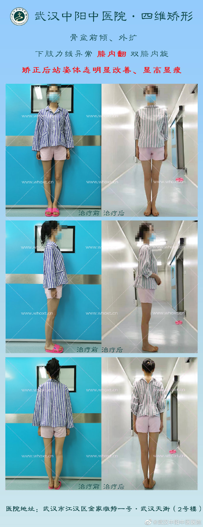 武汉中阳中医院：怎样改变O型腿？四维矫形技术七天无痕塑腿型