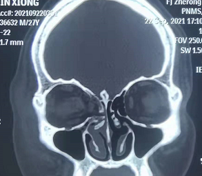 眼眶内侧壁骨，高难度手术福州爱尔“熊猫”医生用微小切口巧妙化解