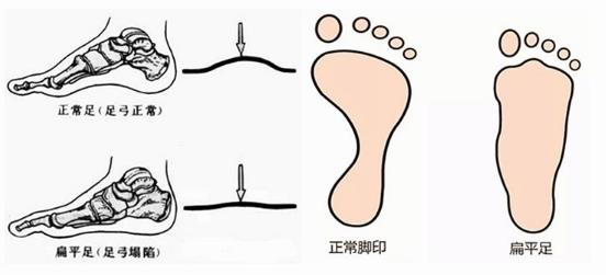 扁平足能跑步吗？扁平足跑步有什么危害？