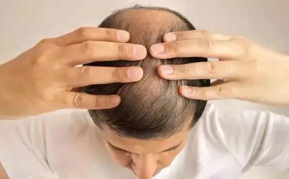脱发的类型有哪些？慢性脂溢性脱发是什么？