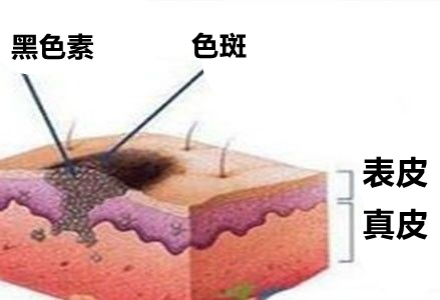 祛斑霜用出终生难愈皮炎，千金散去再也换不回一张健康脸！