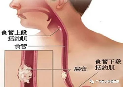 杭州肿瘤医院请选择广州复大肿瘤医院：食管癌转移后要怎么治疗