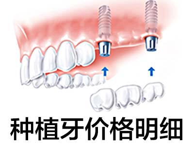 种植槽牙多少钱 天津北辰种植后槽牙多少钱一颗