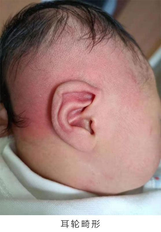 新生儿耳廓畸形会自己长好吗？成都民生耳鼻喉医院矫正效果如何