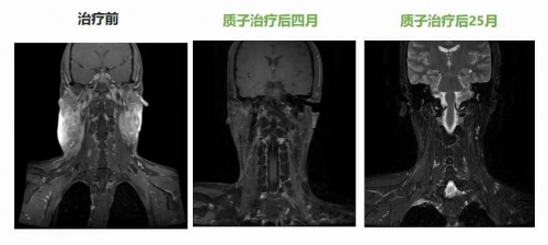 肿瘤放疗“皇冠上的明珠”质子治疗，竟比普通放疗更“省钱”