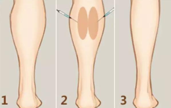 肌肉腿打瘦腿针有用吗 塑形用时短便捷不反弹