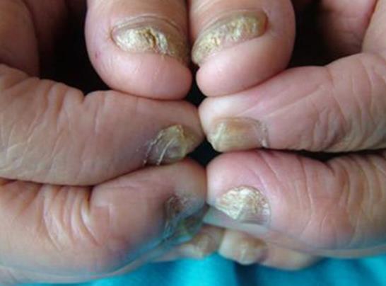 灰指甲是什么原因造成的 个人环境真菌感染身体病变