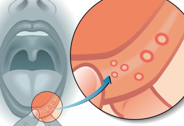 口腔溃疡是什么原因造成的 消化系统疾病内分泌变化遗传因素