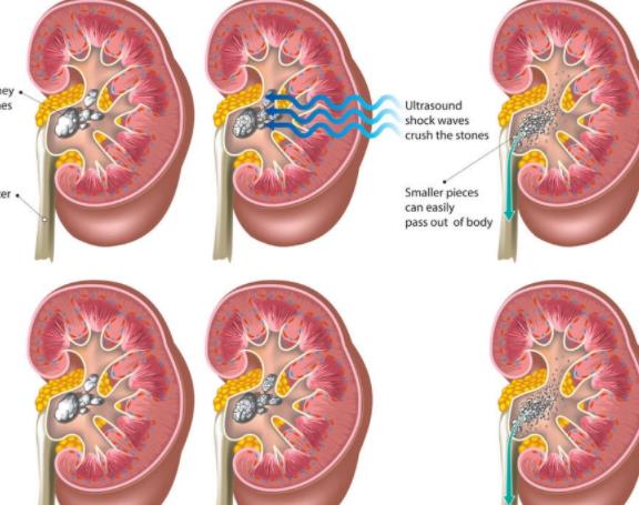 肾结石怎么引起的 排泄功能故障尿酸多草酸沉淀多