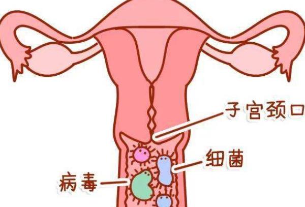 急性宫颈炎主要症状有哪些 白带多呈脓性息肉下腹坠痛