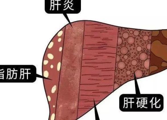 脂肪肝有哪些因素引起 肥胖,酒精,糖尿病,药物等