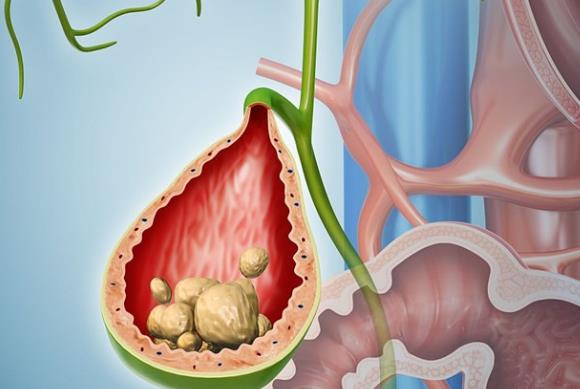 胆结石怎么形成的 胆汁成分失调淤积胆囊病变
