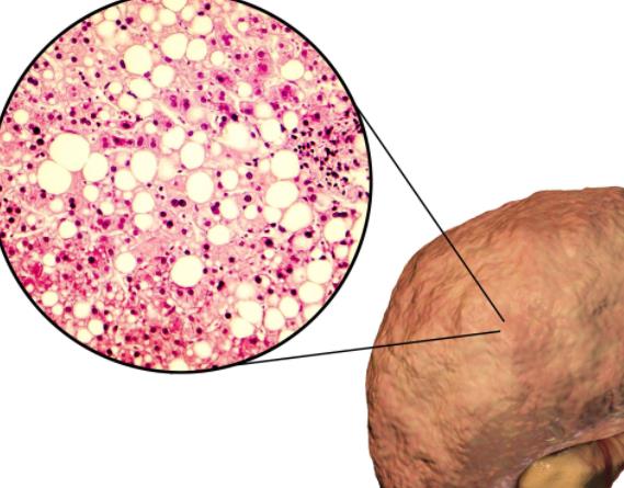 脂肪肝有什么危害 贫血肝脏肿大腹水下肢水肿