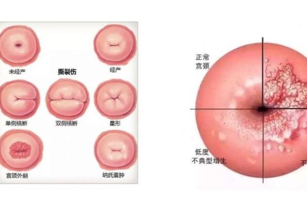 慢性宫颈炎能自愈吗 复发性强及时清洁就诊