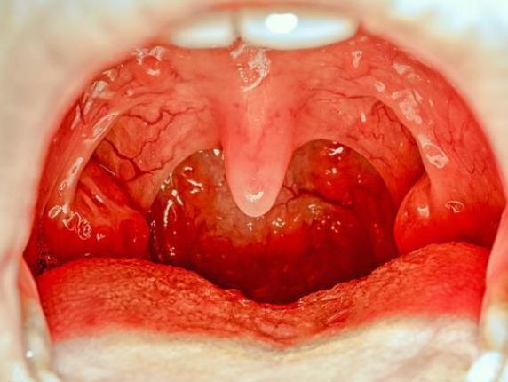 咽炎怎么治才能彻底根除 吃药就医多喝水清淡饮食