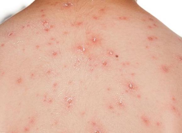 水痘第几天停止生长 3-5天结痂1-2天出疹个性差异