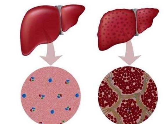 肝硬化早期症状 疲倦恶心腹胀静脉曲张